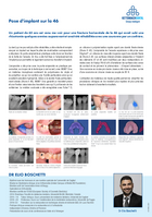 Pose d'un implant sur la dent 46