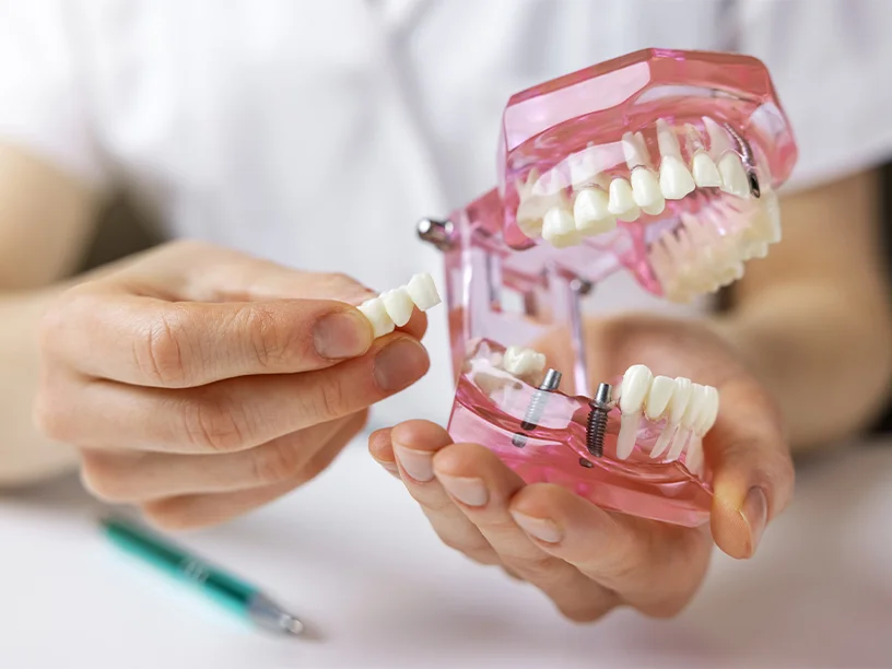 Model for fitting new teeth